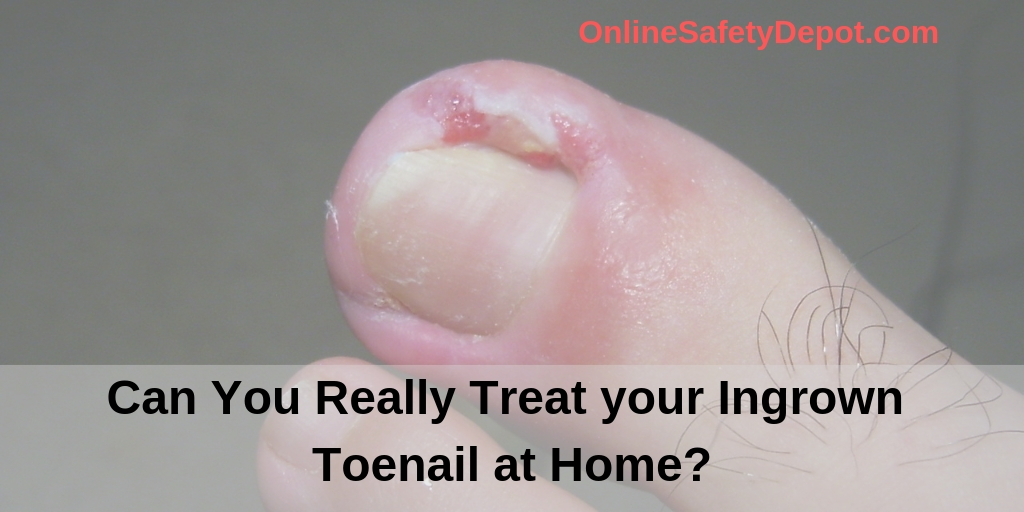 Can You Really Treat your Ingrown Toenail at Home?